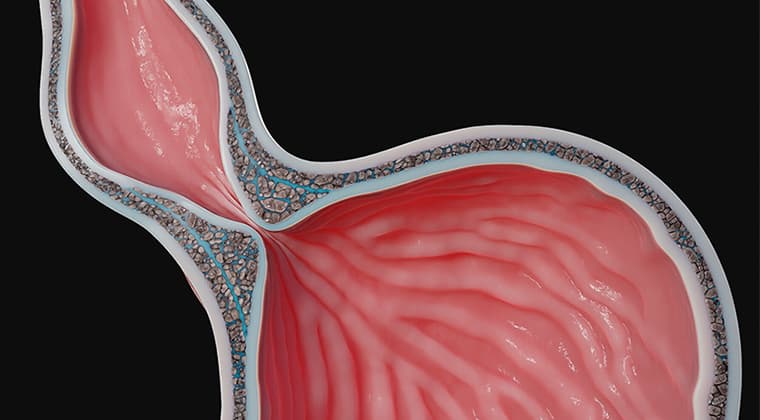 Acalasia
