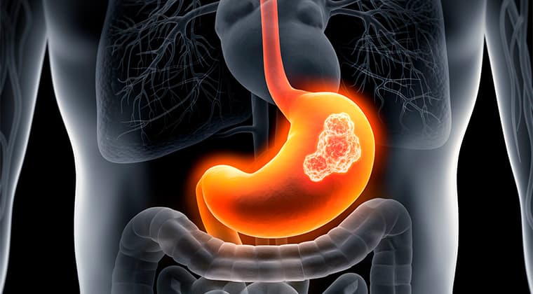 Cáncer de estómago