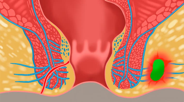 Fístula intestinal y abscesos anales