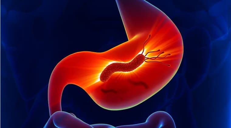 Infección por Helicobacter pylori