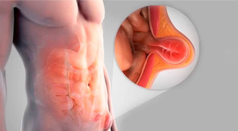 Hernias de pared abdominal, inguinal y umbilical