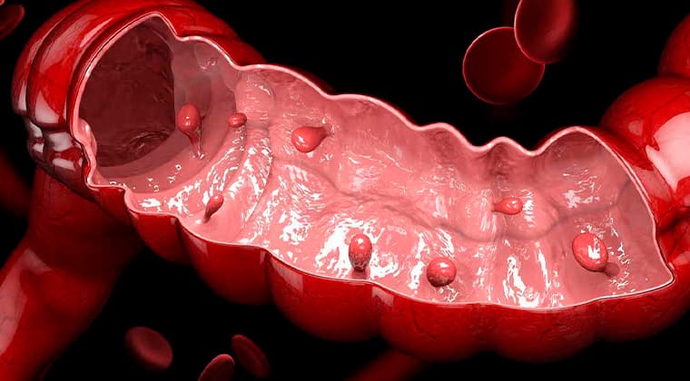 Pólipos gastrointestinales