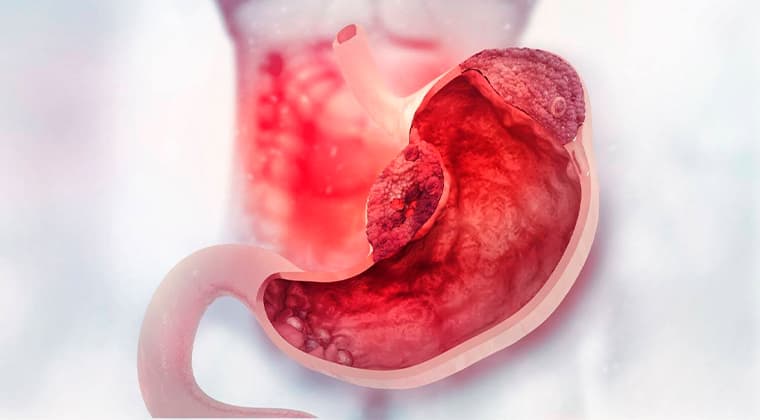 Tratamiento abierto y laparoscópico para cáncer de estómago