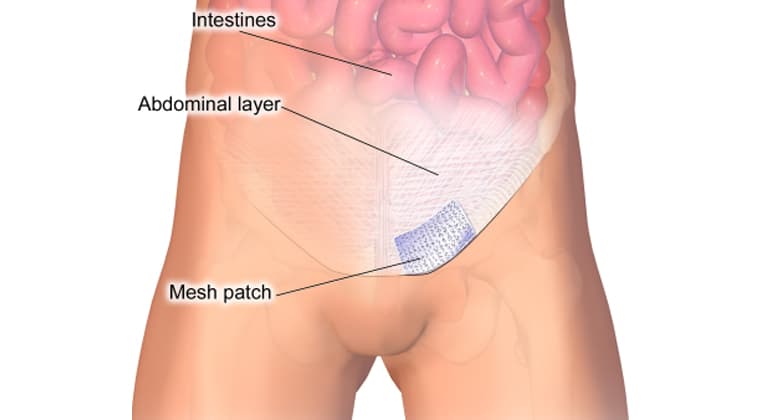 Plastias de hernias abdominales