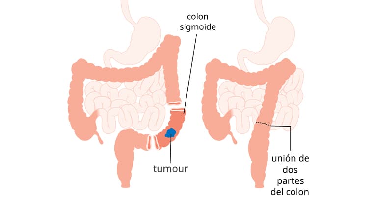 Resecciones intestinales abiertas y laparoscópicas