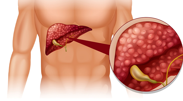 Piedras de Vesícula (Colelitiasis)