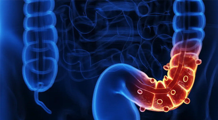 Cirugía para diverticulitis